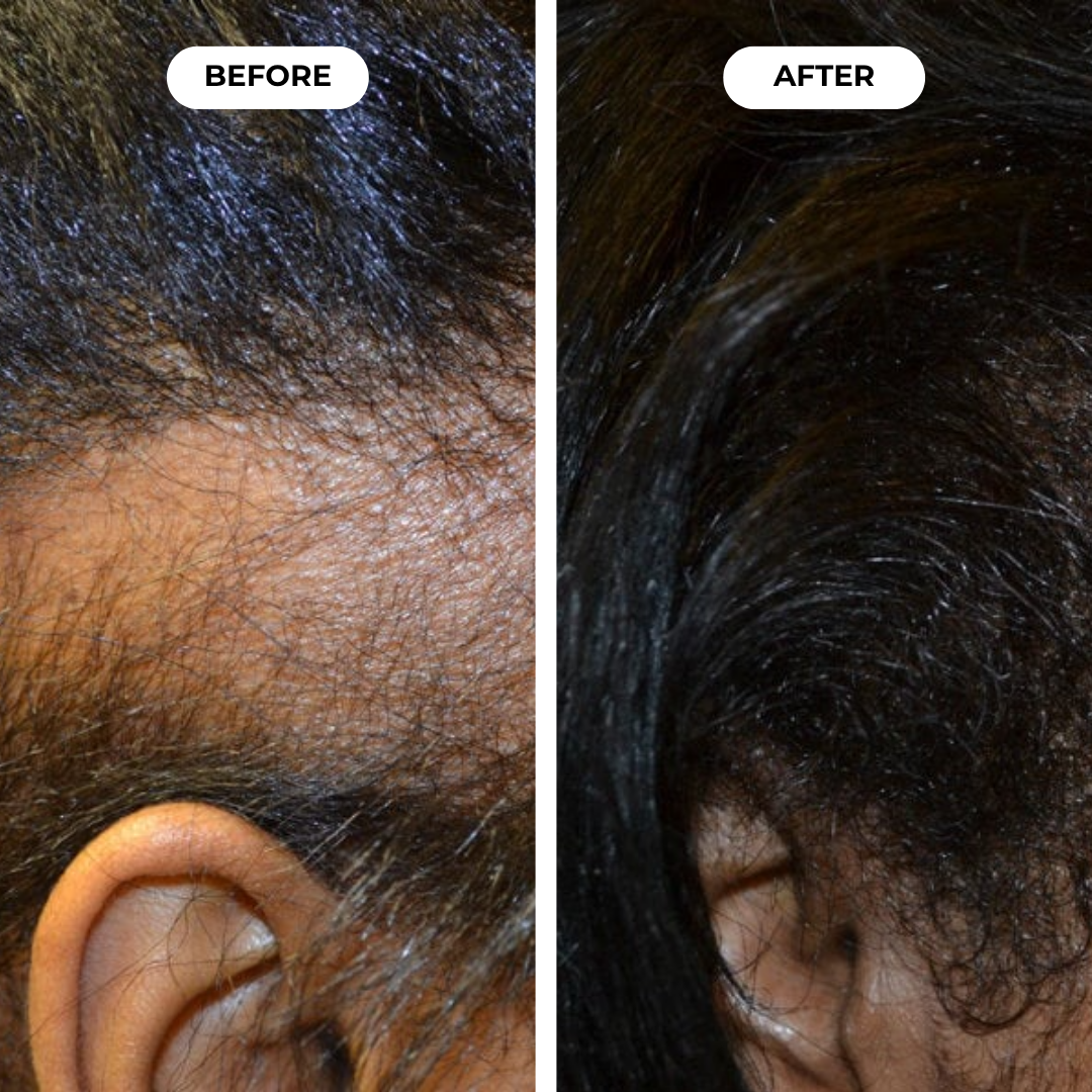 Hairbloom Hair Growth Gummies