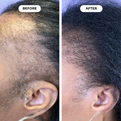 Hairbloom Hair Growth Gummies