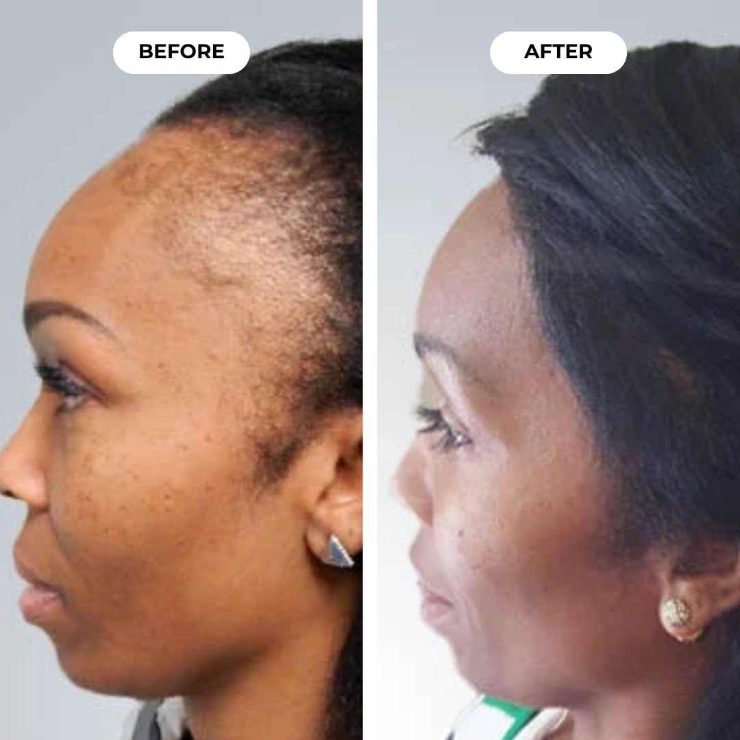 Hairbloom Hair Growth Gummies