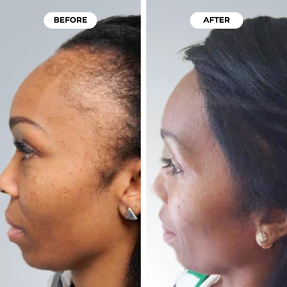 Hairbloom Hair Growth Gummies