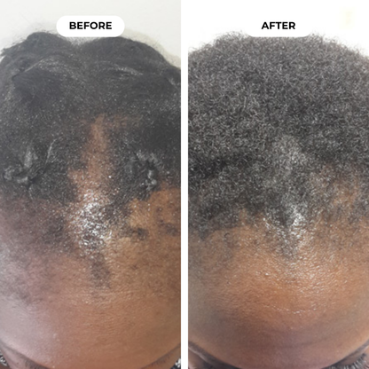 Hairbloom Hair Growth Gummies